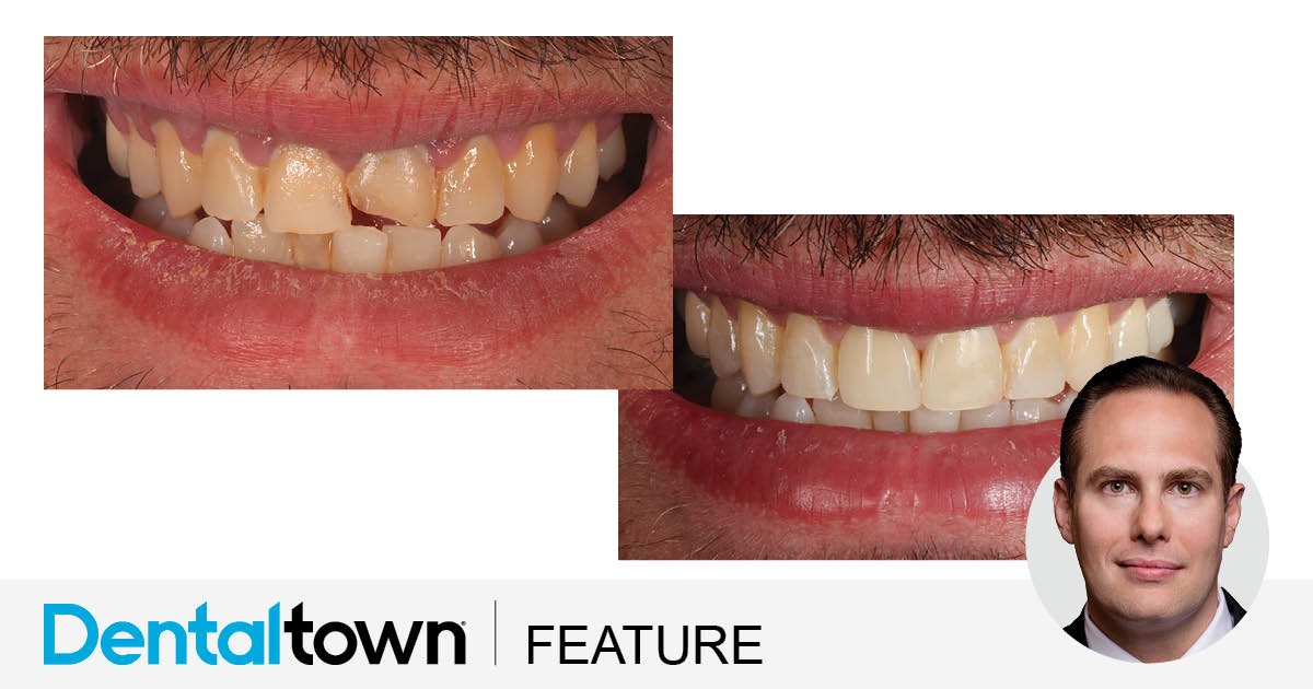 Show Your Work: Full-Contour Veneers and a Fantastic Hygienist Dr. Arthur R. Volker shares a case study of a patient who hadn’t been to a dentist for more than 15 years and came in with
a fractured front tooth.