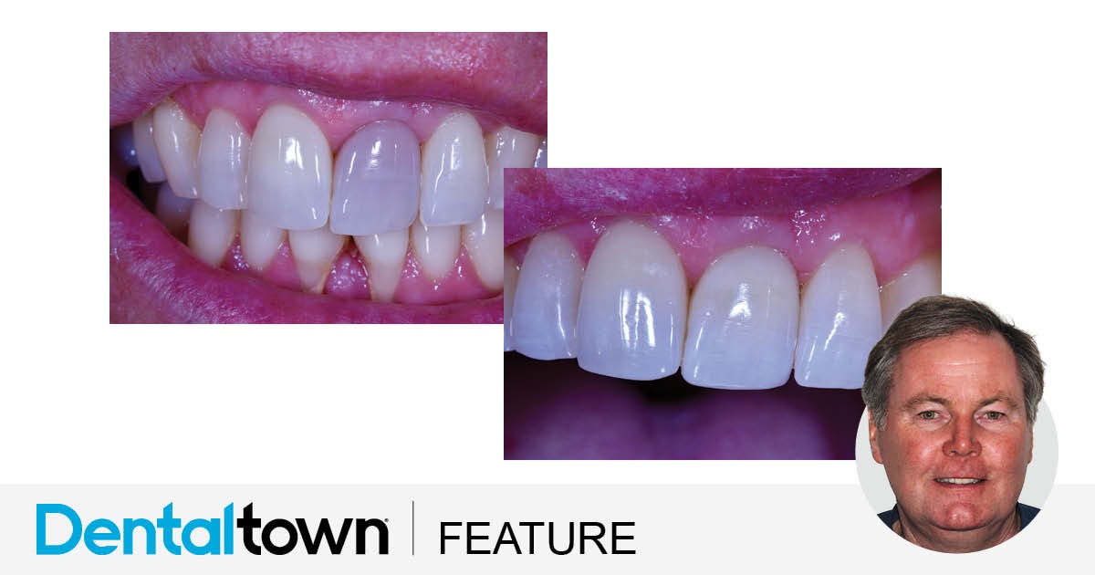 Bleaching Discolored Endodontically Treated Teeth Dr. Terry Shaw, one of the most-followed members on Dentaltown’s message boards, discusses how he approaches the treatment of endodontically treated discolored teeth, and shares three case studies illustrating his steps and successes.
