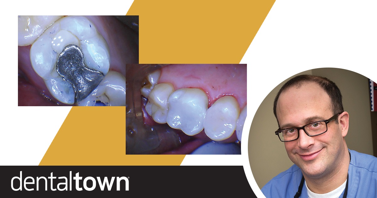Show Your Work: Working at Light Speed  Dr. Joshua Weintraub shares a case in which he used a laser to remove old amalgam and prepare teeth for restoration.
