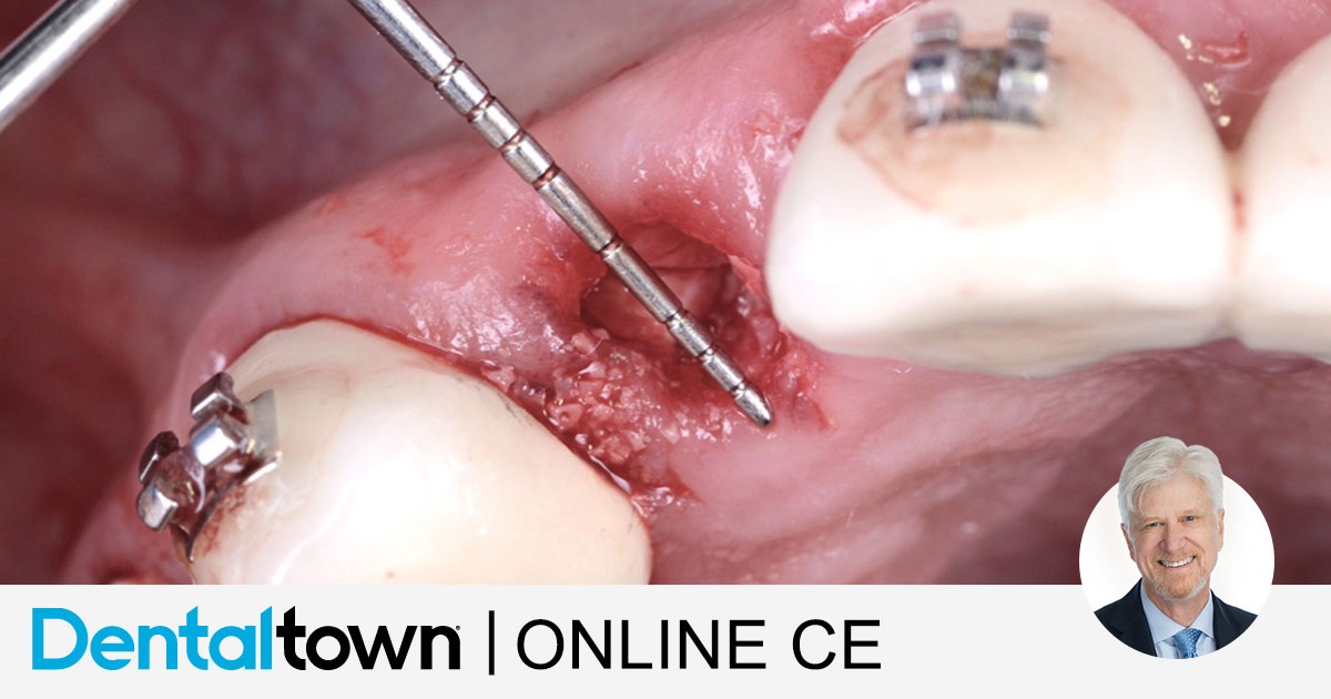Timothy F. Kosinski, DDS One-Step Alveolar Ridge Preservation Without the Need for a Membrane