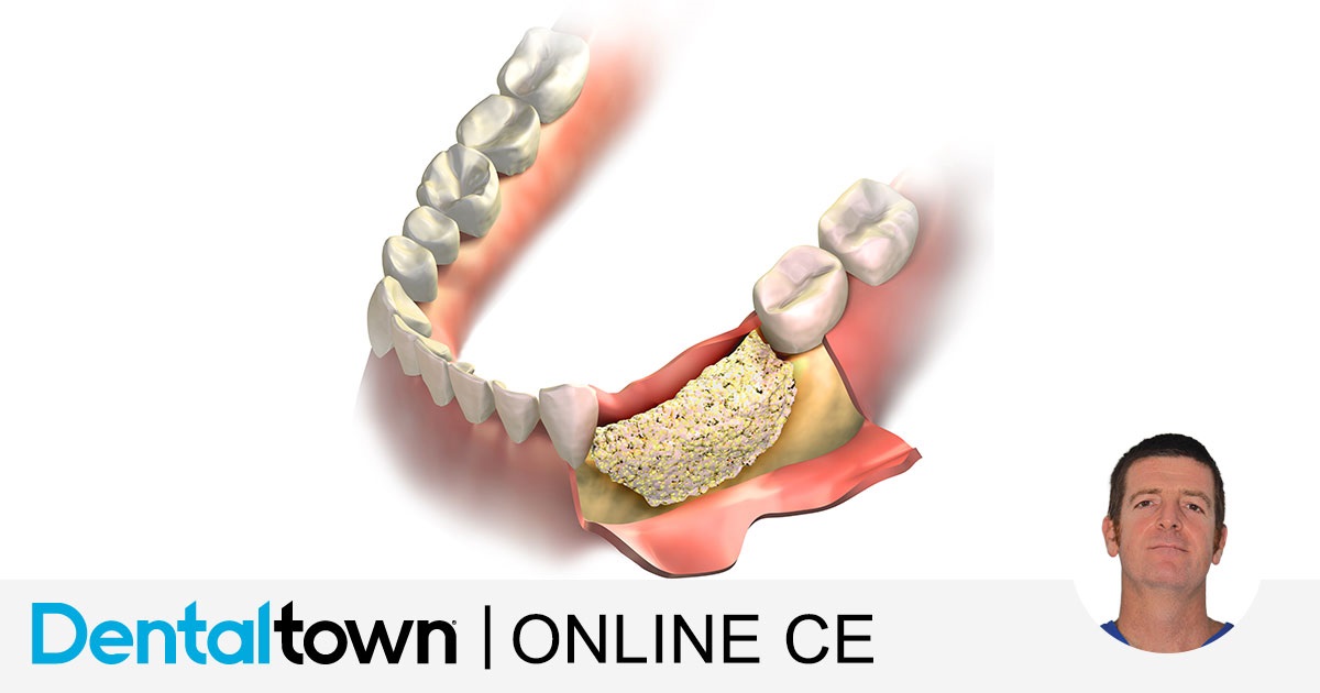 Dr. Giacomo Tarquini All You Ever Needed to Know About Guided Bone Regeneration